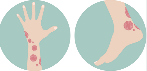 Psoriasis