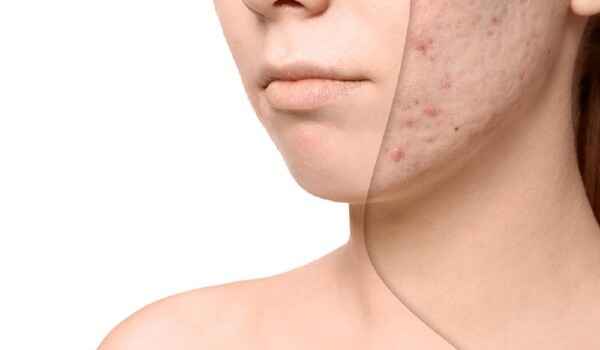 A Guide for Laser Treatment for Acne Scars