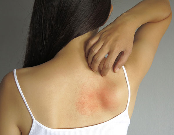 eczema symptoms-treatments