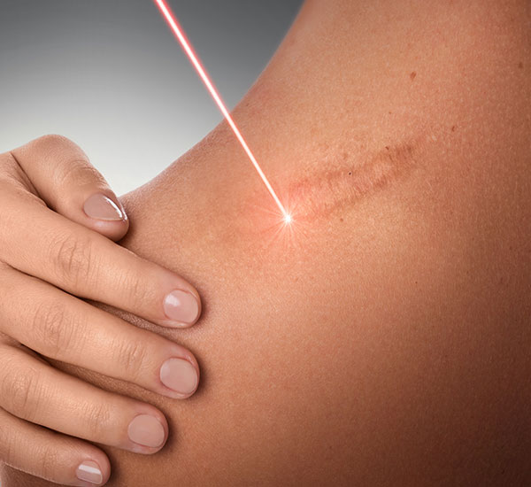 keloid treatment bangalore